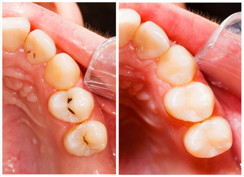 Fillings  Corona, CA 