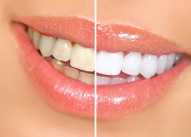 Teeth Whitening  Corona, CA 