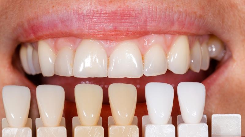 Veneers  Corona, CA 